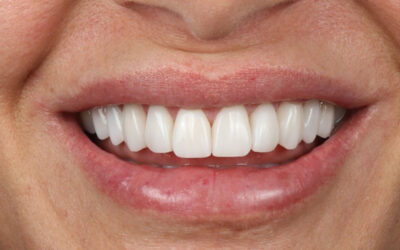 Implantes dentários: o sorriso que realiza sonhos e transforma vidas