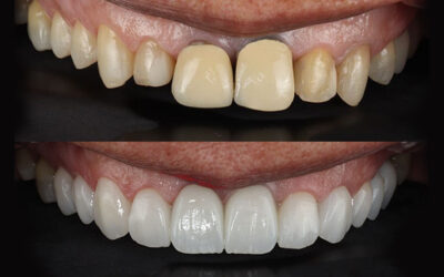 Sorriso perfeito sem medo: como as lentes de contato dentais podem elevar sua confiança