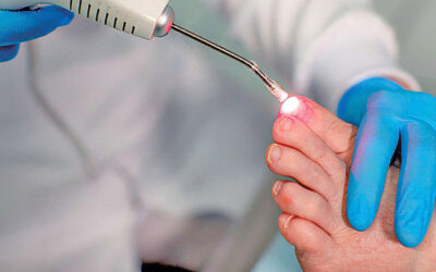 Laserterapia podológica: como a tecnologia a laser ajuda no tratamento de dores, micoses e inflamações