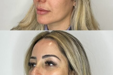 Harmonização Fullface